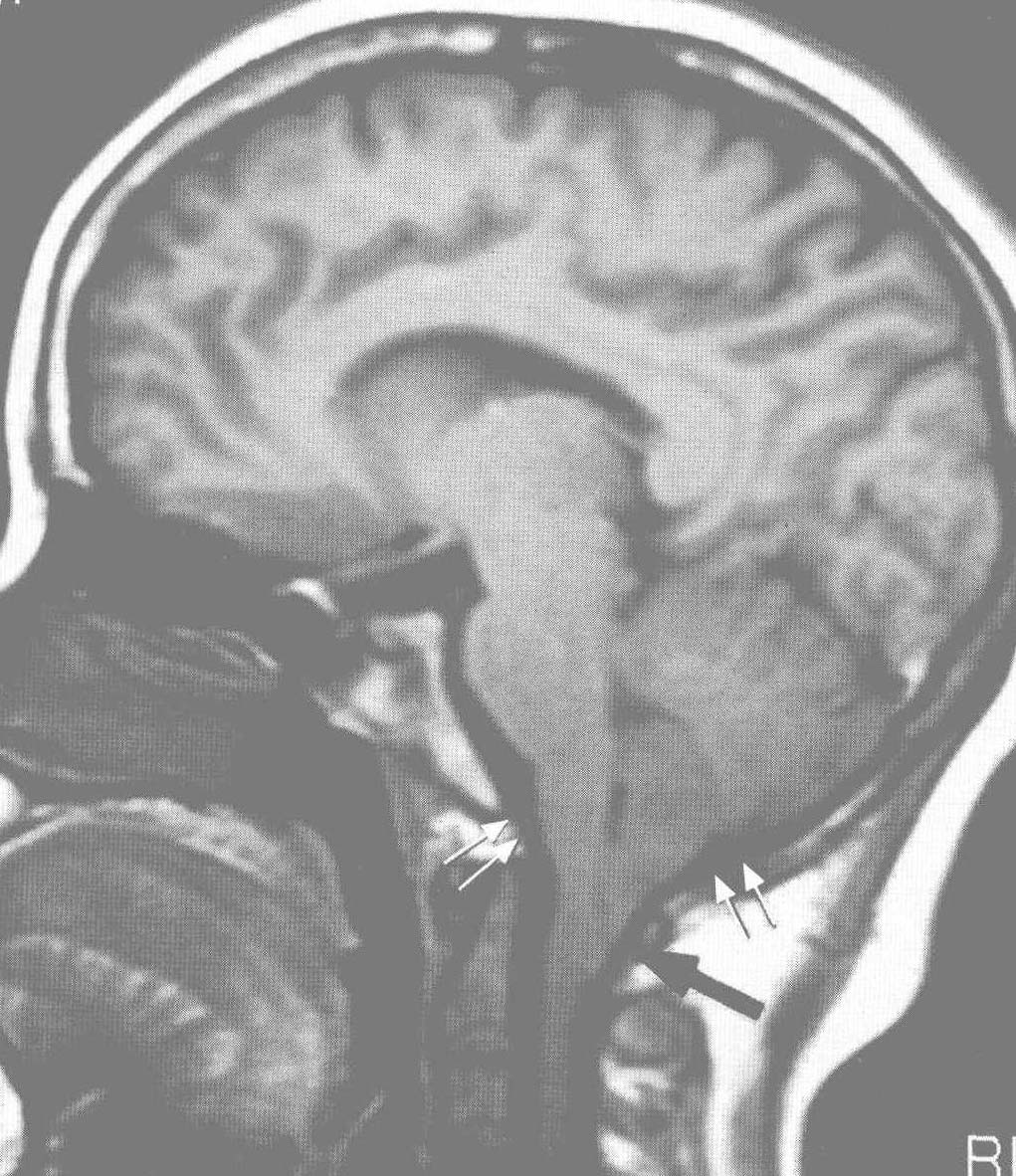 1. Chiari Ⅰ型畸形